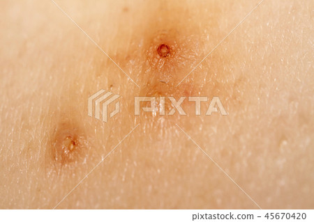 Close up of Molluscum Contagiosum also called water wart 45670420