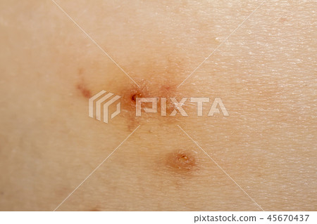 Close up of Molluscum Contagiosum also called water wart 45670437