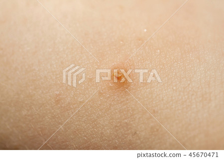 Close up of Molluscum Contagiosum also called water wart 45670471