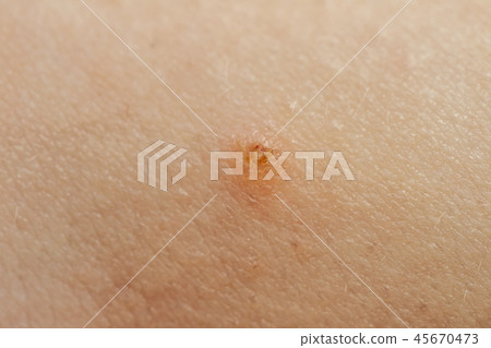 Close up of Molluscum Contagiosum also called water wart 45670473