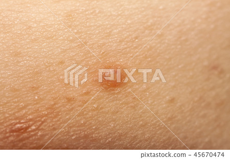 Close up of Molluscum Contagiosum also called water wart 45670474