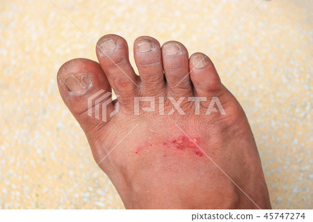 foot wound becomes infected apply medication foot wound becomes infected apply medication 45747274