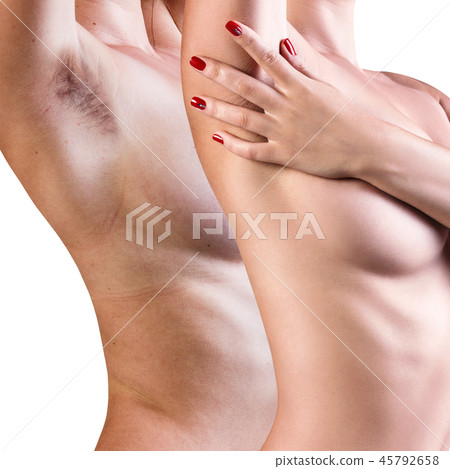 Woman showing her armpit before and after hair removal. Woman showing her armpit before and after hair removal. 45792658