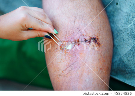 extraction of drainage from wound with tweezers extraction of drainage from wound with tweezers 45834826