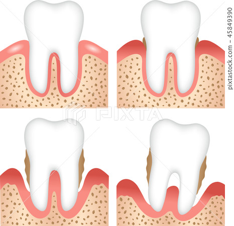 牙周病的進展 45849390
