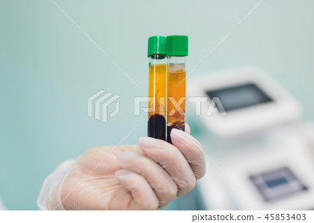 Preparing for Plasmolifting. Blood tubes in two layers divided by centrifuge after. cosmetic Preparing for Plasmolifting. Blood tubes in two layers divided by centrifuge after. cosmetic 45853403