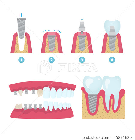 Dental crowns and implantation Dental crowns and implantation 45855620