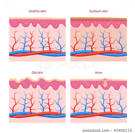Skin types healthy, sunburn and old acne vector set Skin types healthy, sunburn and old acne vector set 45908213