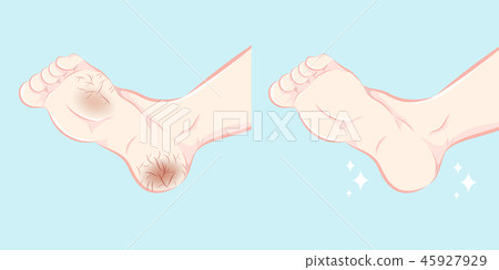 Feet with dry skin Feet with dry skin 45927929