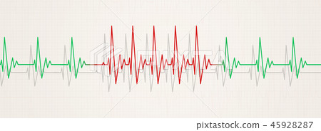 sudden arrhythmia illustration 45928287