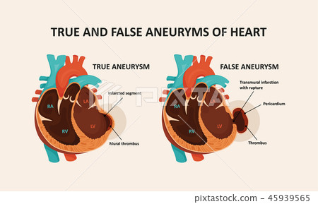 True and false (pseudoaneurysm) aneuryms of heart True and false (pseudoaneurysm) aneuryms of heart 45939565
