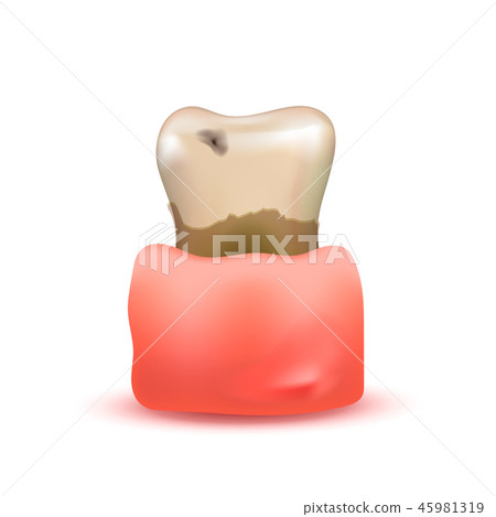 Sick and rotten realistic human tooth with caries 45981319