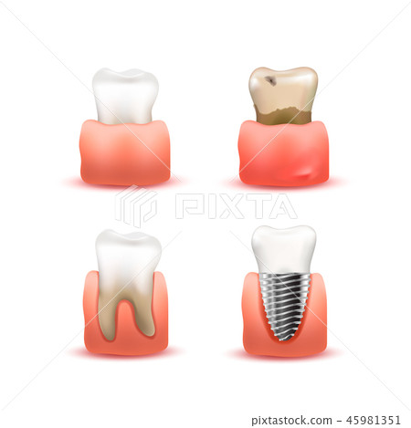 Set of different tooth in gums 45981351
