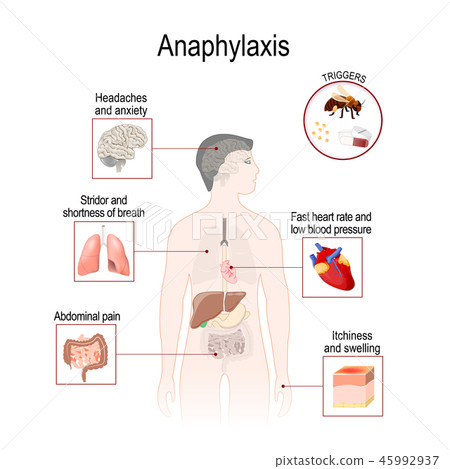 Anaphylaxis is a serious allergic reaction Anaphylaxis is a serious allergic reaction 45992937