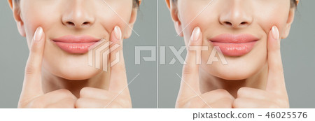 Woman lips before and after lip filler Woman lips before and after lip filler 46025576
