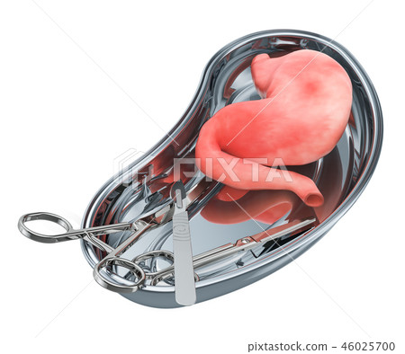 Stomach transplant surgery concept. Donor stomach Stomach transplant surgery concept. Donor stomach 46025700