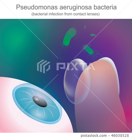 Bacterial infections from contact lenses Bacterial infections from contact lenses 46038528
