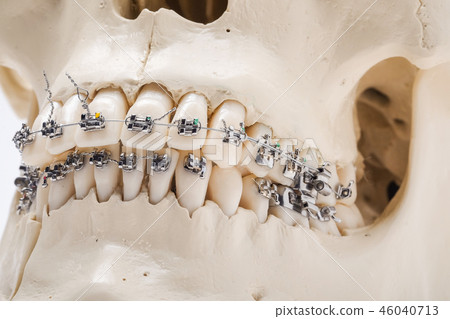 otthodontic braces bracket wire 46040713