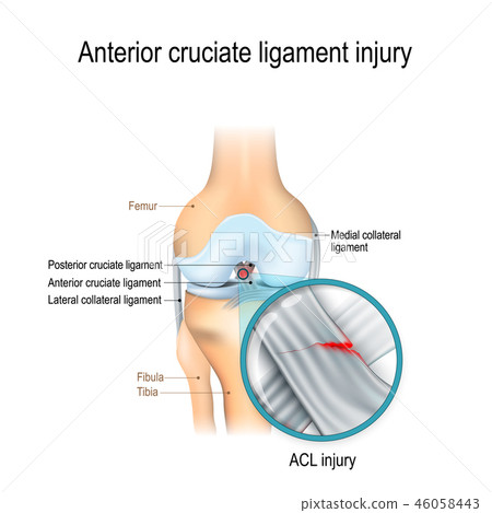 Anterior cruciate ligament injury 46058443