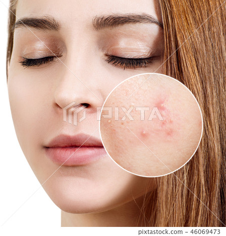 Young woman with acne skin in zoom circle. 46069473