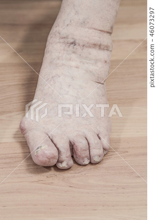left foot with arthritis, damaged nails 46073297