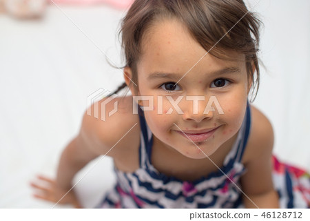 Little girl with varicella, chicken pox, small pox 46128712