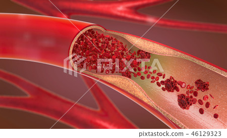 Constricted and narrowed artery  or blood vessel 46129323