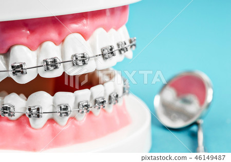 Close up tooth model with metal wire dental braces Close up tooth model with metal wire dental braces 46149487