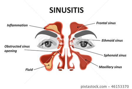 Sinusitis. Healthy and inflammation nasal sinus Sinusitis. Healthy and inflammation nasal sinus 46153370