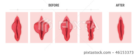 Labiaplasty Labiaplasty 46153373