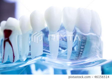 Dentist dental teeth implant Dentist dental teeth implant 46156514