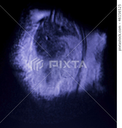MRI knee meniscus tear scan 46156525