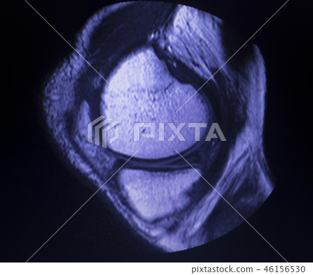 MRI knee meniscus tear scan 46156530
