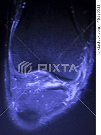 MRI knee meniscus tear scan MRI knee meniscus tear scan 46156531