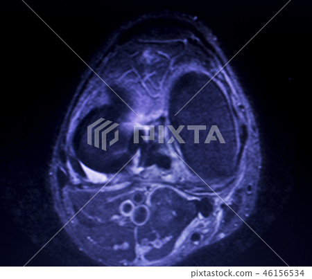 MRI knee meniscus tear scan 46156534