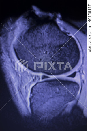 MRI knee meniscus tear scan 46156537