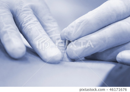 Dry needling EPI needle 46171676