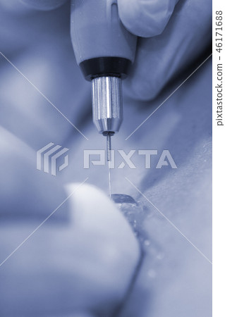 Dry needling EPI needle 46171688