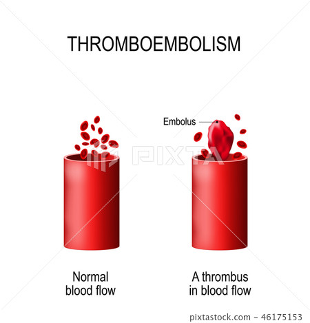 Thromboembolism 46175153