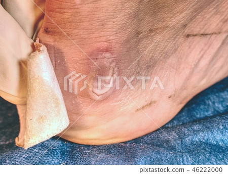 Mediciman treat skin on  heel.  Nasty damaged skin 46222000