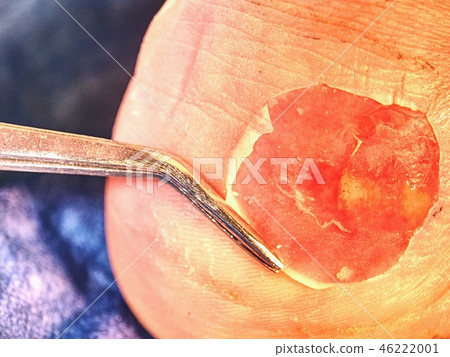 Cut treatment of dead skin and abrasions on heel. 46222001