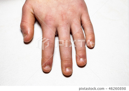 Close up of hand with bitten finger and fingernails. Close up of hand with bitten finger and fingernails. 46260898