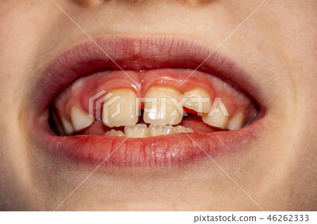 Close-up of child of eight years with the problem of not loosing his baby teeth 10 month after 46262333