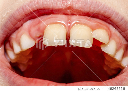 Close-up of child of eight years with the problem of not loosing his baby teeth 10 month after Close-up of child of eight years with the problem of not loosing his baby teeth 10 month after 46262336