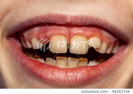 Close-up of child of eight years with the problem of not loosing his baby teeth 10 month after 46262356