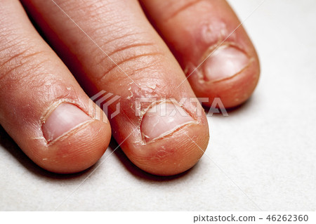 Close up of hand with bitten finger and fingernails. 46262360