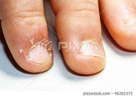 Close up of hand with bitten finger and fingernails. Close up of hand with bitten finger and fingernails. 46262371