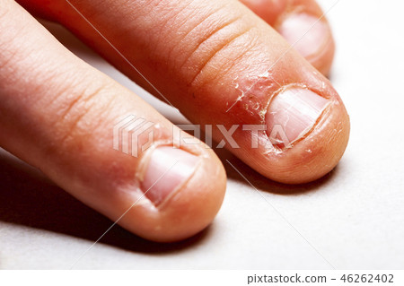 Close up of hand with bitten finger and fingernails. Close up of hand with bitten finger and fingernails. 46262402