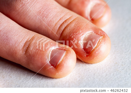 Close up of hand with bitten finger and fingernails. Close up of hand with bitten finger and fingernails. 46262432