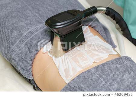 Woman getting cryolipolysis fat treatment 46269455
